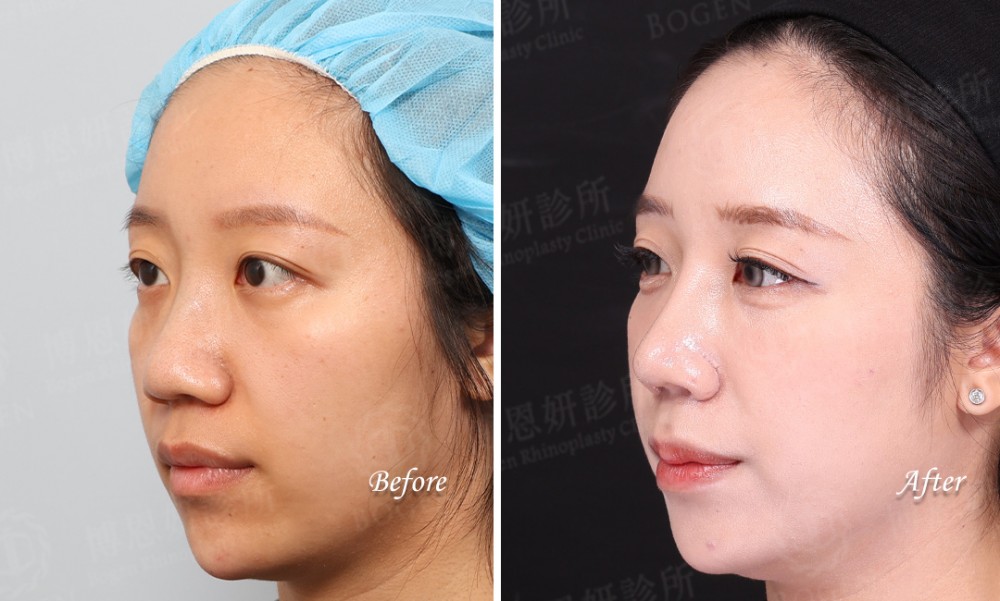 韓式隆鼻,結構式隆鼻,縮鼻翼手術,博恩妍